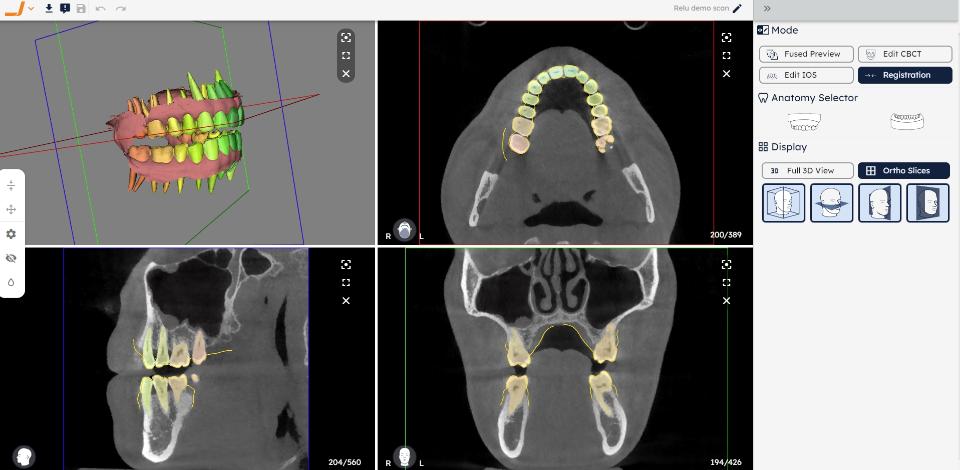 Fig. 2: Un ejemplo de superposición totalmente automatizada de CBCT y escaneos intraorales utilizando la plataforma Relu® Creator (Relu, Lovaina, Bélgica)