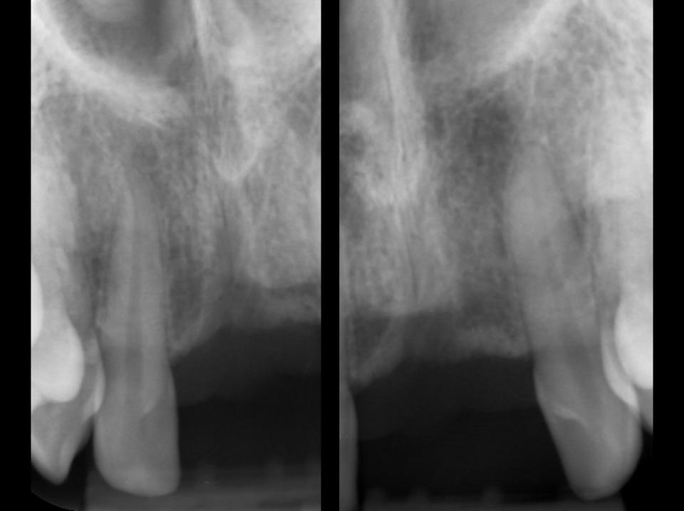 Fig. 5b: Fechamento ortodôntico. Radiografias periapicais da maxila anterior após a remoção cirúrgica de 11 e 21. Não há sinais radiográficos de lesões no 12 ou 22.