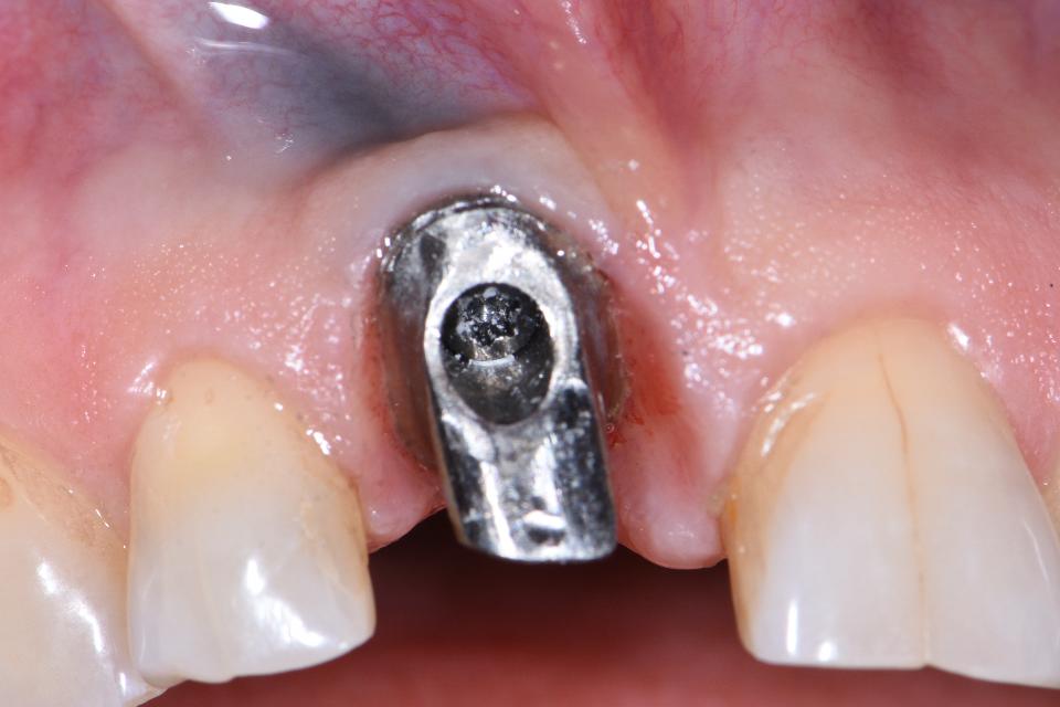 Fig. 2: Décoloration grisâtre de la muqueuse péri-implantaire.