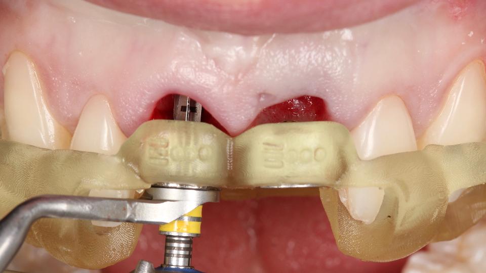 Abb. 5d: Statische computergestützte implantologische Operation mit vollständig geführtem Protokoll für die Sofortimplantation – Region 11 – zweite Bohrung (ø 2,8 mm) während der Präparation des Implantatlagers