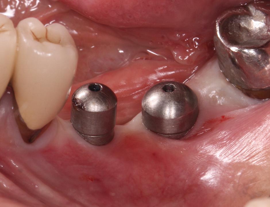 Fig. 2a: This case illustrates peri-implantitis at site #19,20 as observed in clinical photographs and radiographic images. A lack of buccal keratinized mucosa was also noted