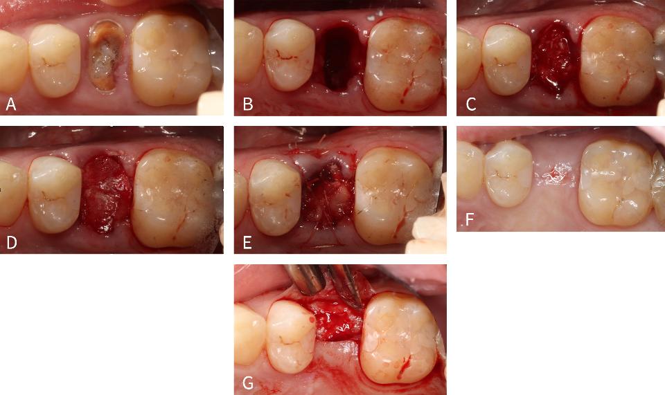 Fig. 6: Uso de FRP em combinação com um enxerto de osso alógeno para preservação de crista. (A) Vista oclusal de segundo pré-molar superior perdido (#25). (B) Vista oclusal após extração dentária minimamente traumática. (C) Colocação do osso pegajoso no local da extração. (D) Uma membrana reabsorvível de colágeno reticulado foi colocada sobre o alvéolo de extração. (E) Uma membrana FRP foi criada e dobrada para ser colocada sobre a membrana de colágeno e fixada com suturas. (F) 4 meses após a operação, observe a excelente manutenção da crista. (G) Elevação de retalho de espessura total exibindo excelente qualidade óssea antes da colocação do implante. (Caso realizado pelo Dr. Nathan Estrin).