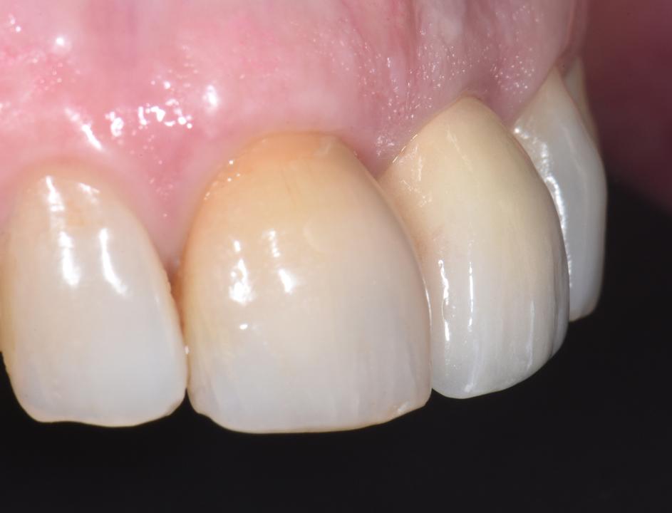 Fig. 5n: Lateral view of the maxillary left central incisor implant prosthesis 3 years after implant placement showing an ideal emergence profile