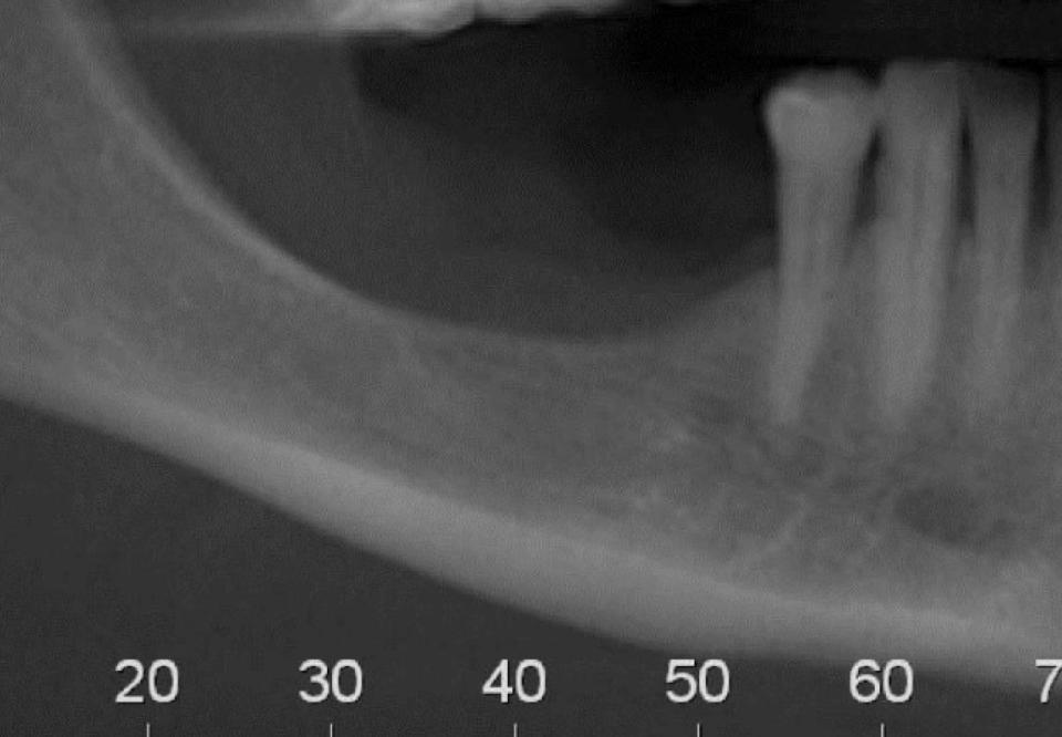 Fig 3b: Preoperative CBCT showing posterior mandible deficiency