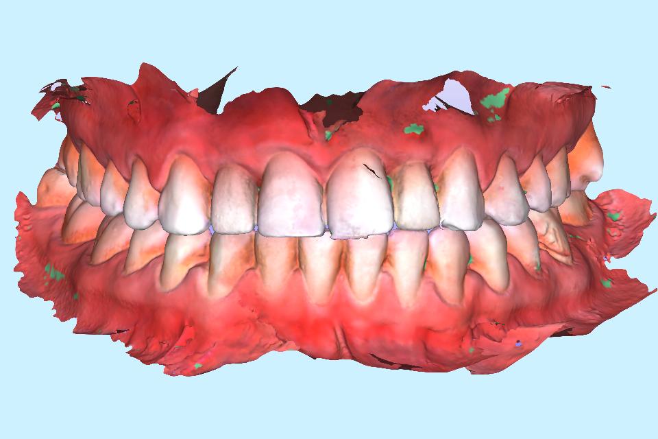 Fig. 26: Example PLY file representing a post-operative intraoral scan