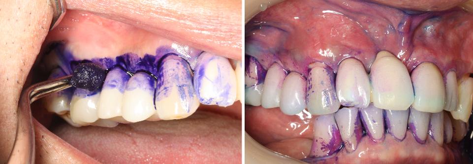 Şekil 7b: Destekleyici peri-implant bakım protokolleri, her hasta için bireysel olarak uyarlanmalı ve hastaya implantlarda ve dişlerde plak birikimlerinin varlığını göstermek için kullanılan bir çözeltiyi içermelidir.
