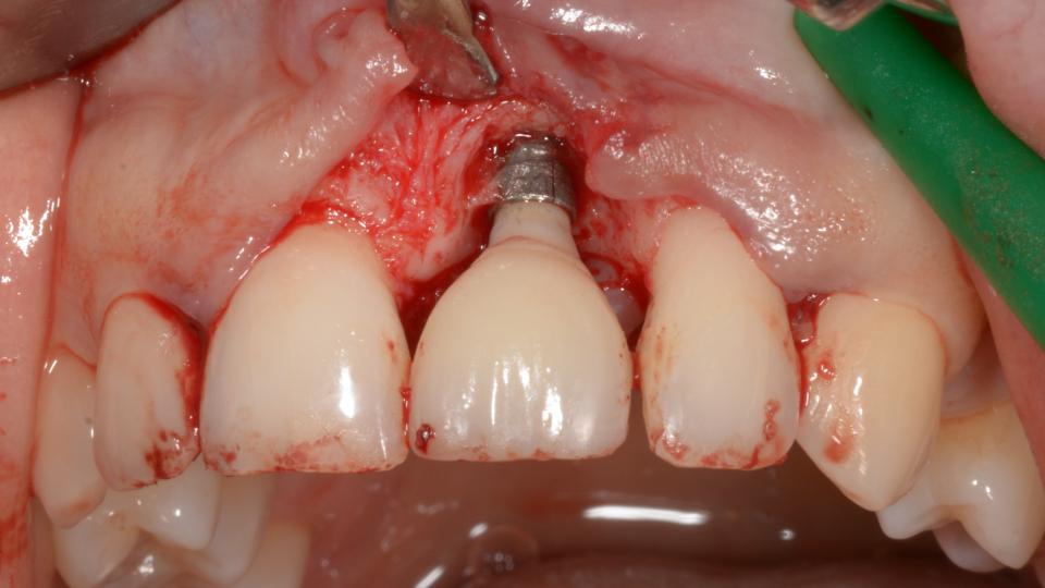 Fig. 6b: La chirurgie exploratoire révèle la fissure et les dommages inflammatoires consécutifs sur l'os environnant.