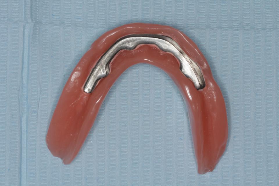 Fig. 11: Telescopic CAD/CAM bar with matching telescopic structure incorporated in the denture