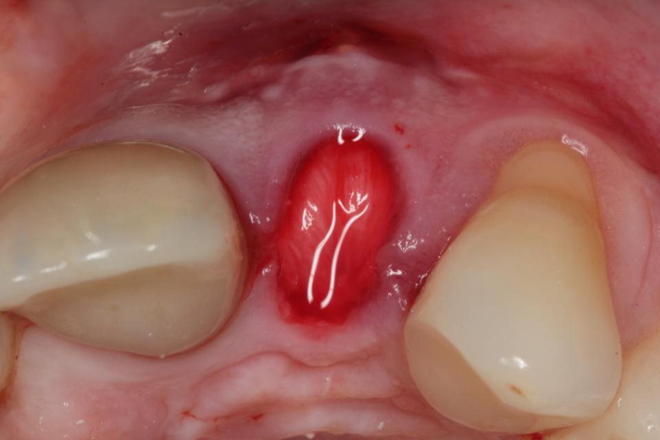 Fig. 47: The collagen membrane is flipped over the bone graft and fixed underneath the palatal soft tissue