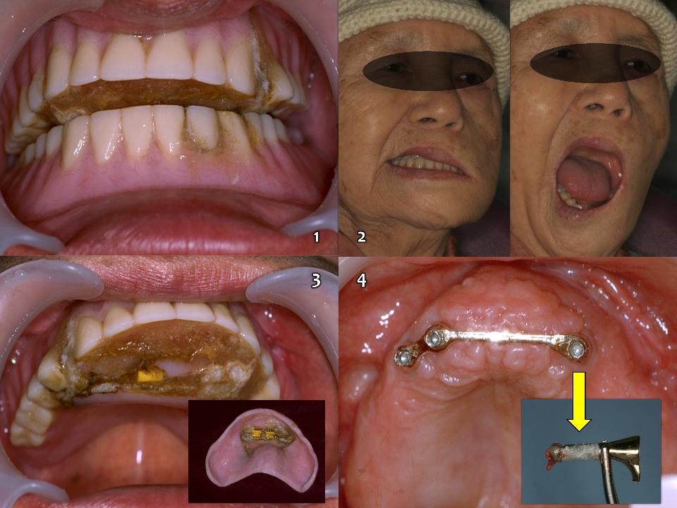 Fig. 17b: Also an elderly disabled patient from a private dental clinic (1). Is this a growing and mutating denture? This 82-year-old female patient was suffering from facial paralysis for over 10 years (2). I found a small amount of exposed yellow material on the denture palate (3). This was a plastic clip for the bar-joint structure. The bar structure had already fractured and one implant on the left gone out from the structure (4)