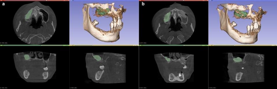 Fig. 7: An example of automated segmentation of the bone graft material on the maxillary sinus floor in immediate postoperative (green areas in a) and six-month follow-up (green areas in b) CBCT images, using the deep learning model by Tao et al. (Tao, Xu et al. 2023)