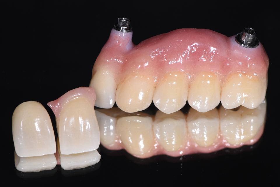 Fig. 4a: Final reconstruction with pink porcelain