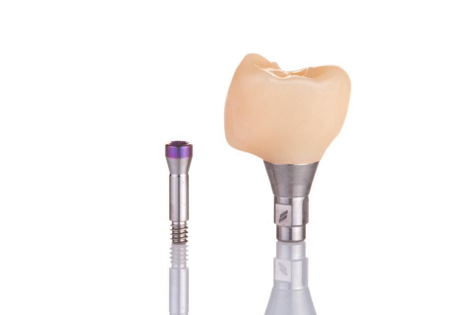 Fig. 3r: Provisional crown cemented to the titanium abutment extra-orally with resin cement