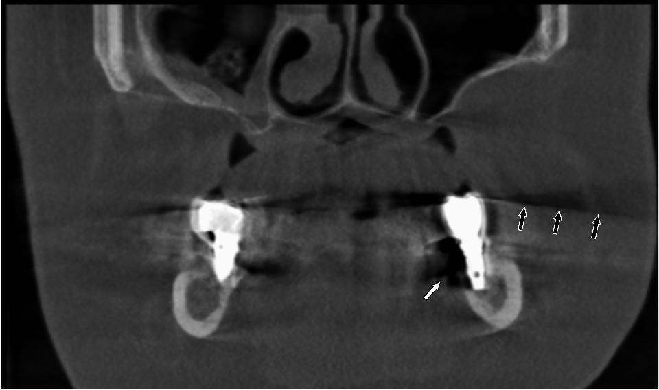 Fig. 2: Cone-beam computed tomography coronal reconstruction of a patient presenting two dental implants in the mandibular molar region. The white arrow indicates image deterioration, more prominent in the lingual aspect of the dental implant, preventing proper assessment of bone-to-implant contact and the level of the lingual cortical bone. Black arrows indicate the upper limit of an artifact segment, illustrating the cone-beam effect