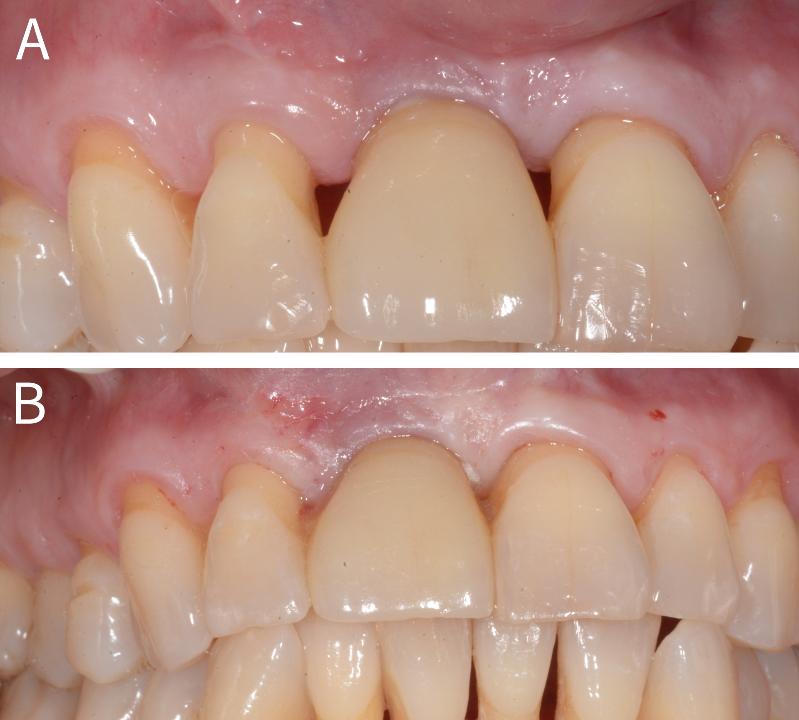 Fig. 14: (A) Foto clínica demonstrando dentes anteriores superiores com vários black spaces. (B) Fotos clínicas finais após injeções. (Caso realizado pelo Dr. Ezio Gheno; reimpresso com permissão de Miron 2021).