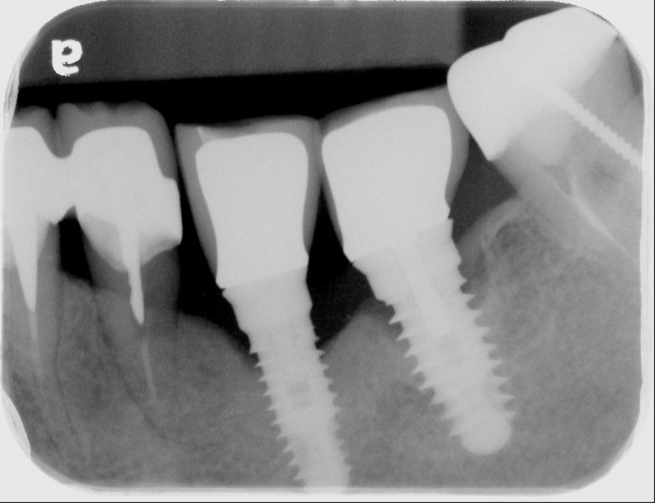 Şekil 2b: Klinik fotoğraflarda ve radyografik görüntülerde 35-36 numaralı kadranda görülen peri-implantitis vakası. Ayrıca bukkal keratinize mukozanın eksikliği de not edilmiştir