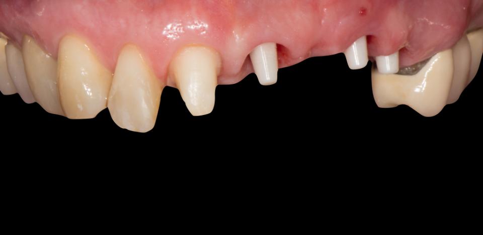 Fig. 5b: After placement of three 1-piece zirconia implants for single and 3-unit fixed partial dentures (Photo credit: Stefan Roehling)
