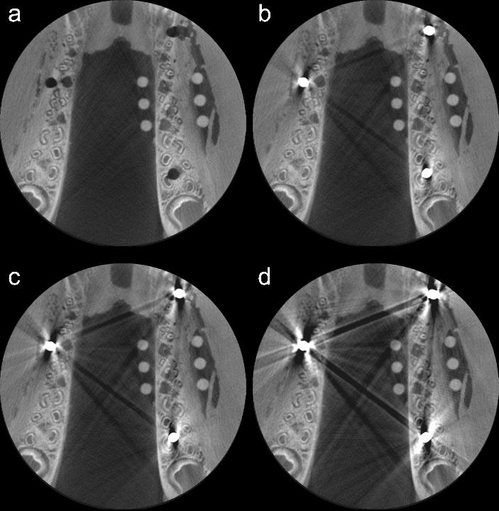 Fig. 8: Reconstruction axiale d’une même mandibule de porc à partir d’images de tomographie à faisceau conique, sans implant dentaire (a) et avec trois implants en titane (b), titane et zircone (c) et zircone (d). On notera l’ampleur variable des artefacts.