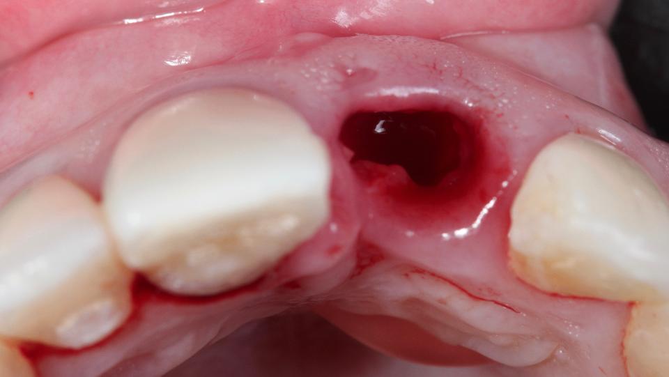 Fig. 2f: Minimally invasive technique for flapless tooth extraction – occlusal view after extraction. Note the preservation of the soft tissue architecture