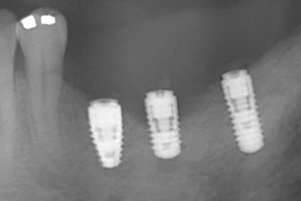 Fig. 4b: La pellicola radiografica mostra un'evidente perdita di osso intorno all'impianto nel sito 3.5 che si estende fino alla parte centrale della fixture