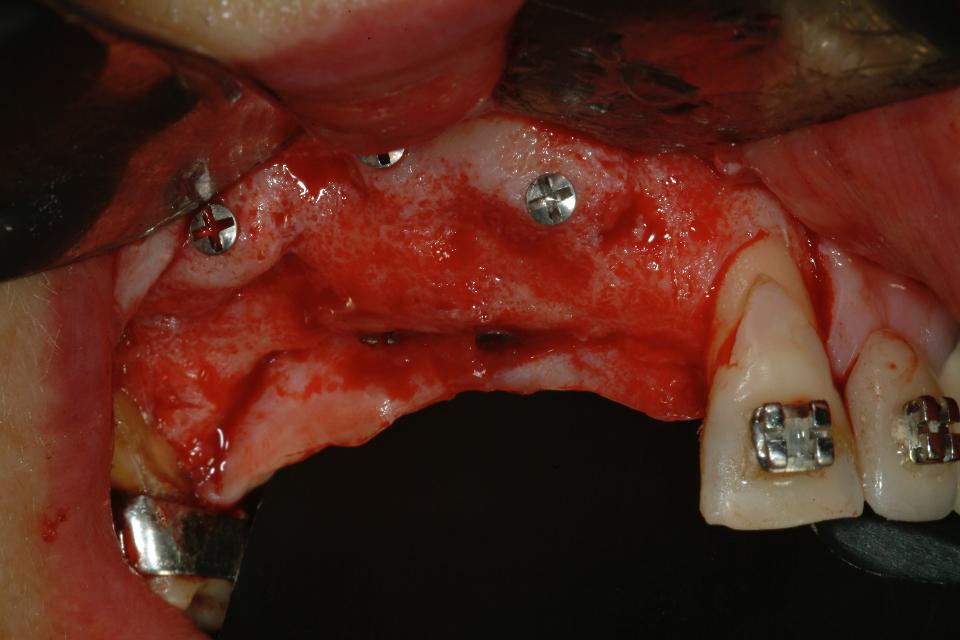 Fig. 5e: Horizontal bone augmentation with ramus block graft, done at time of distractor removal, 3 months after end of distraction. Implants were placed 4 months after horizontal block grafting