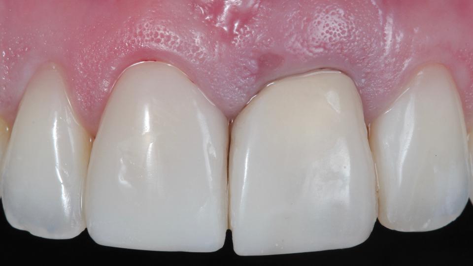 Fig. 2a: Minimally invasive technique for flapless tooth extraction – frontal view at baseline