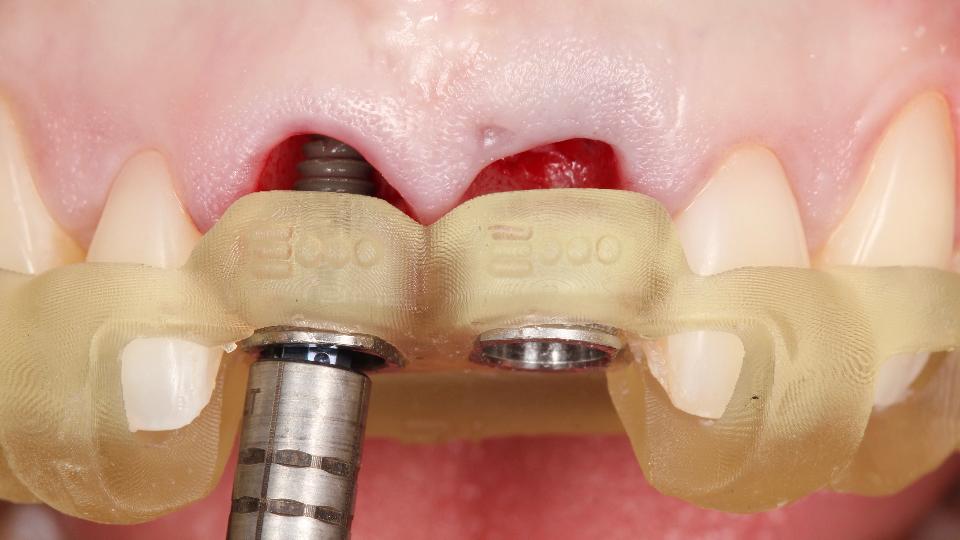 Fig. 5g: Use of the static-computed assisted implant surgery fully-guided protocol for immediate implant placement – region #11 – use of the guided adapter to place the implant with the surgical guide in position