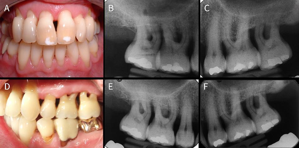 図3: ステージIIIグレードCの広汎型歯周炎に罹患した50歳男性患者の写真（A）と上顎臼歯部のデンタルX線写真（B、C）。上顎大臼歯は、初診時のポケット深さが4mm以上、骨吸収が進行し分岐部病変があったため、予後はquestionableであったが、非外科的歯周治療および外科的治療により、15年間の経過観察まで維持された（D、E、F）。