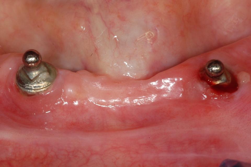 Fig. 1: An 81-year-old female patient, previously treated with two implants supporting an overdenture, presented with swelling, bleeding, and pain in the facial aspect of the left implant, in an area with no keratinized tissue. The implant shoulder is below the mucosal surface, i.e. with the mucosa growing over the implant. Such a situation typically evolves spontaneously into significant inflammation with the loss of KM and peri-implant bone due to plaque accumulation and consequent edema.