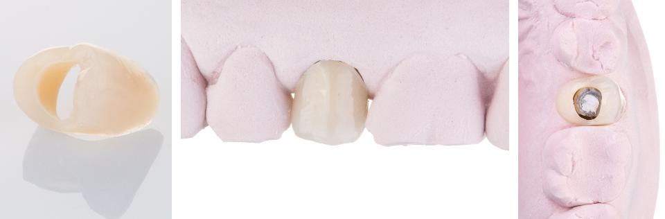 Fig. 3k: A hollowed-out denture tooth is adjusted to fit over the provisional abutment and to conform to the gingival margin of the extracted tooth. Flowable composite or acrylic resin is applied between the abutment and denture tooth to connect the two