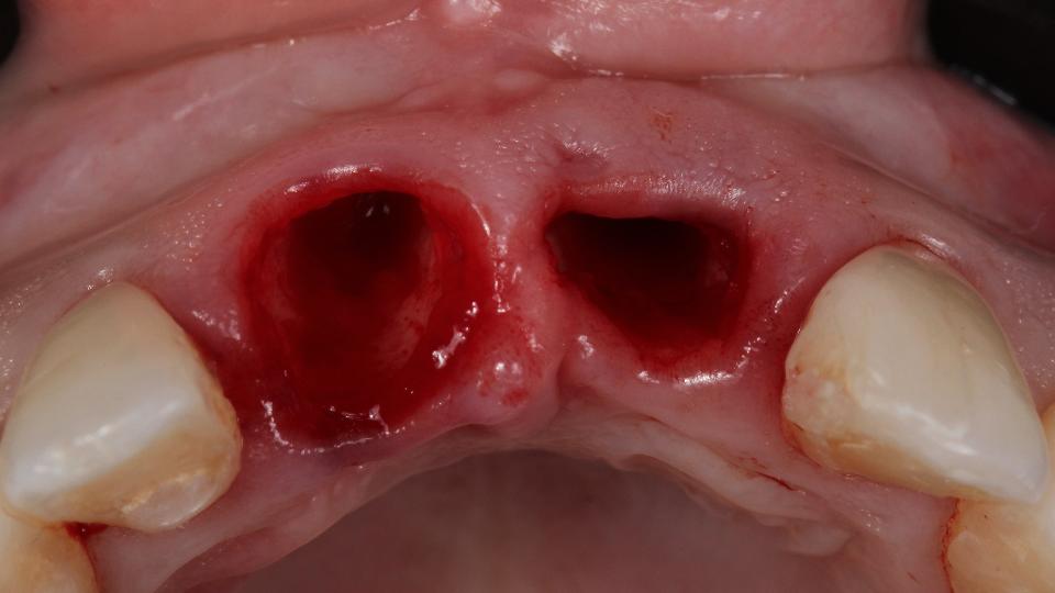 Fig. 6a: Protocollo di tipo 1a – vista occlusale dopo l'estrazione