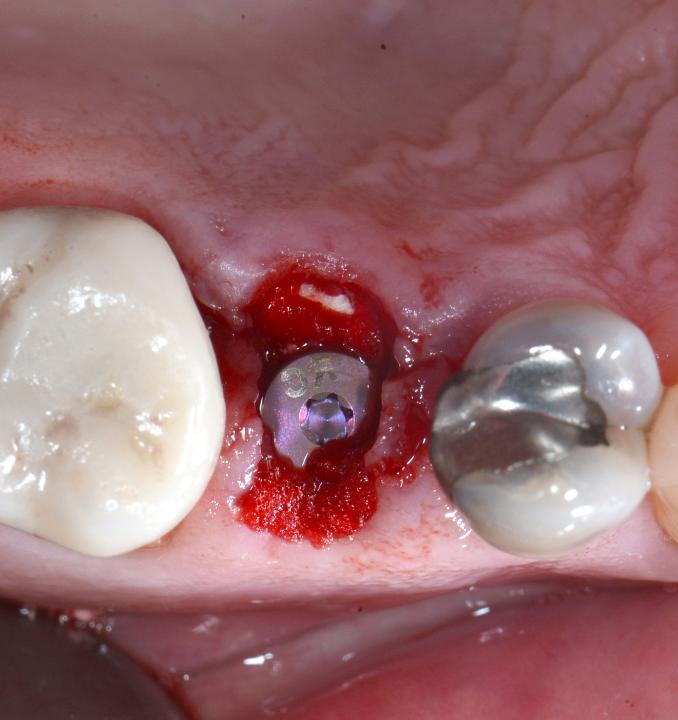 Fig. 6g: The residual facial and palatal defects were grafted with DBBM (BioOss; Geistlich Pharma AG, Wolhusen, Switzerland) and protected with a gelatin sponge (Spongostan; Johnson & Johnson, Ferrosan, Denmark)