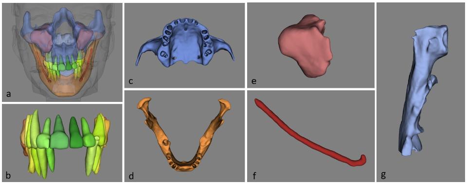 Fig. 4: Ejemplo de segmentación totalmente automatizada de estructuras anatómicas dento-maxilofaciales (a), incluyendo dientes (b), complejo maxilar (c), mandíbula (d), seno maxilar (e), conducto mandibular (f) y faringe (g) en imágenes CBCT utilizando la plataforma Relu® Creator (Relu, Lovaina, Bélgica)