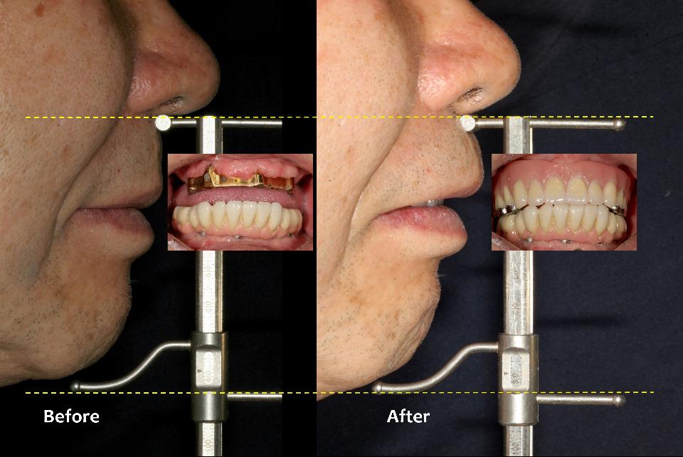 Fig. 8c: Lateral facial appearance of the patient before and after installing the maxillary IOVD. With a combination of a bar-joint structure and 2 magnetic attachments on the bar, this elderly patient has been able to put in, take out and manage hygiene care very comfortably without any help for more than 14 years since 2007 (63 years old at the time)