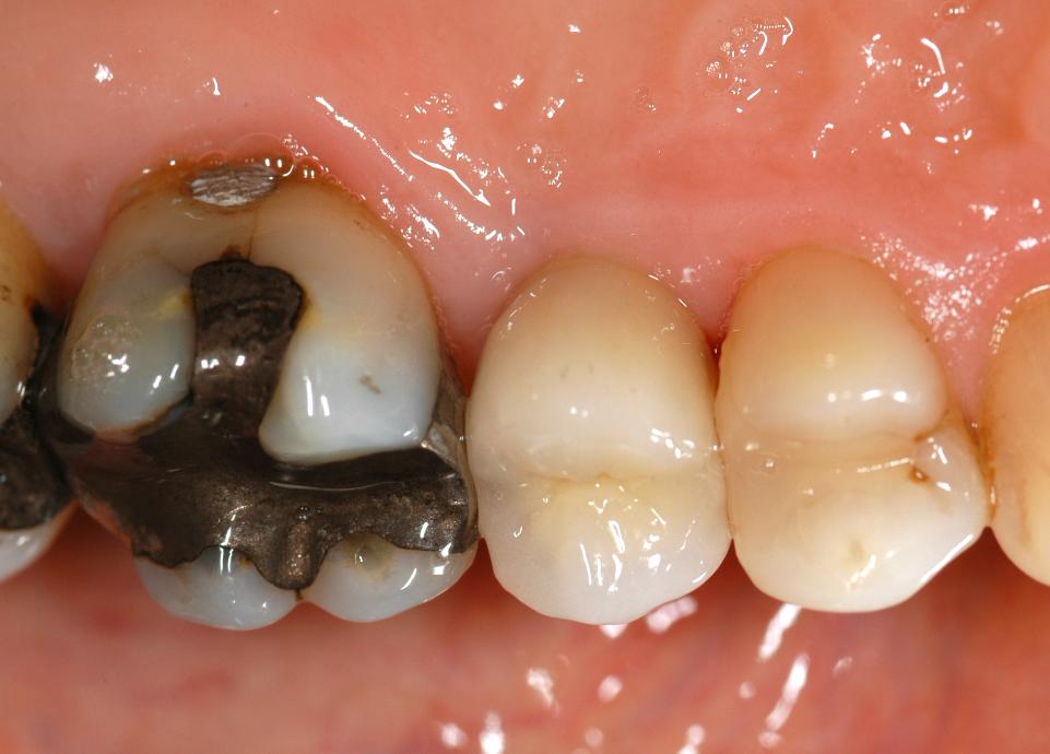 Fig. 4f: Restorative procedures commenced 6 weeks after implant placement and the definitive cement-retained implant crown was delivered one week later (type 1B protocol). This image illustrates the clinical condition 7 months after immediate implant placement