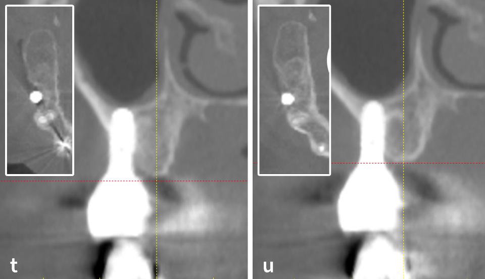 Fig. 3t – u: Confronto tra le immagini CBCT prima dell'intervento (t) e quelle scattate 1 anno dopo l'intervento (u)