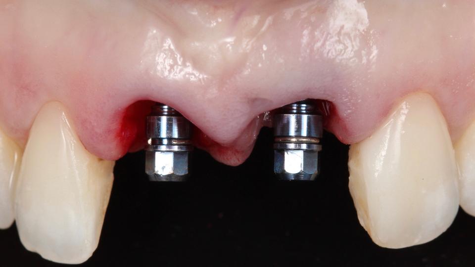 Fig. 7b: Protocole de type 1a - vue frontale après la pose des implants.