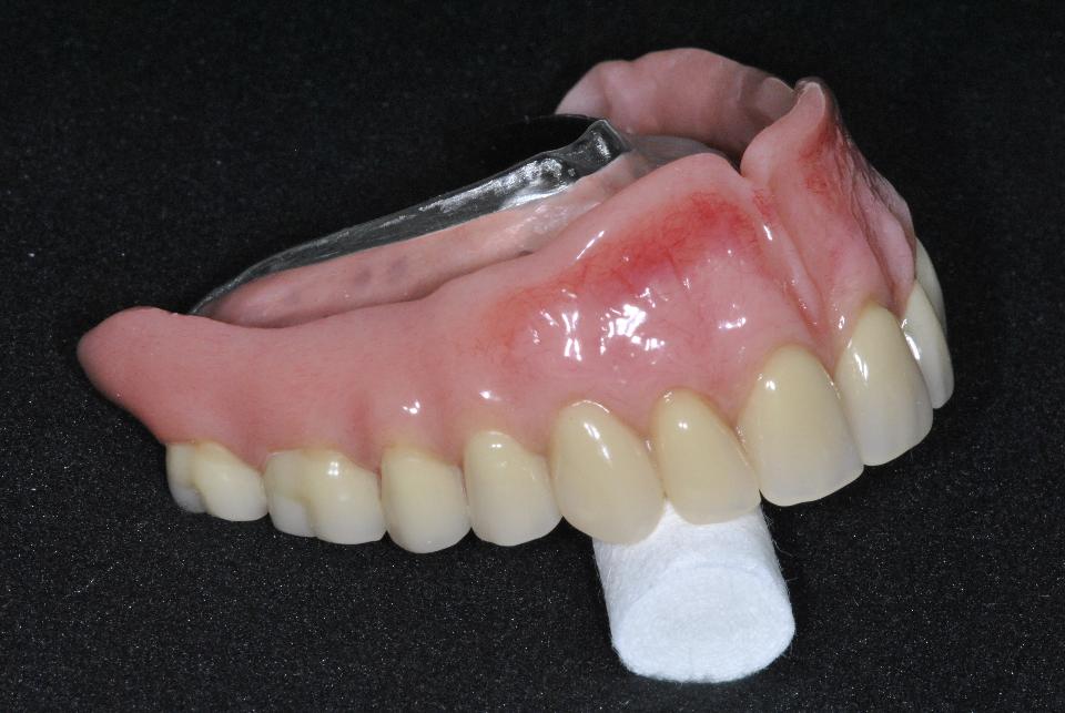 Fig 2c: Depending on the indication, a removable implant-supported, bar-retained prosthesis is recommended for edentulous patients. It can be cleaned more easily than fixed full arch prostheses, but is still extremely stable. Labwork mundwerk dental (Bern)