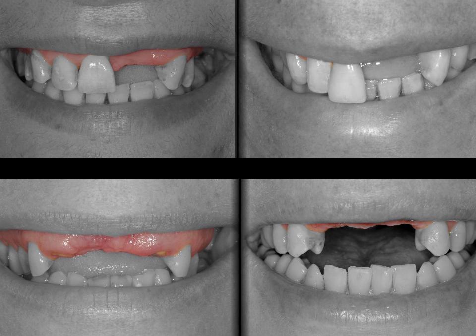 図1: 前歯欠損部のサイズの異なる4つの形態 - スマイルラインとの関係。左上： 中位のスマイルラインの左右非対称欠損部。右上： 低位スマイルラインの左右非対称欠損部。左下： 高位スマイルラインの左右対称欠損部。右下： 中位のスマイルラインの左右対称欠損部