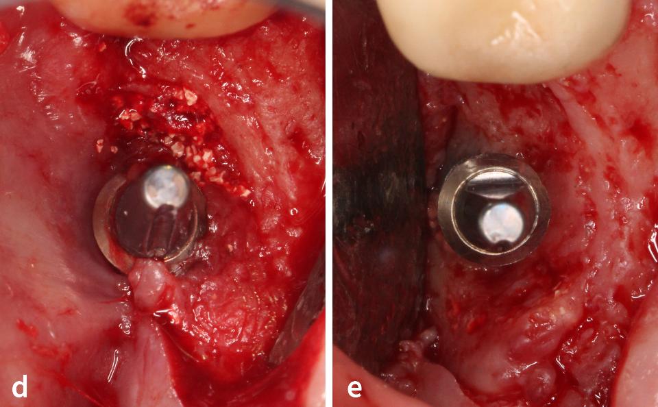 Fig. 3d – e: Before (d) and after (e) the removal of the unintegrated graft-like granule and granulomatous tissue in occlusal view