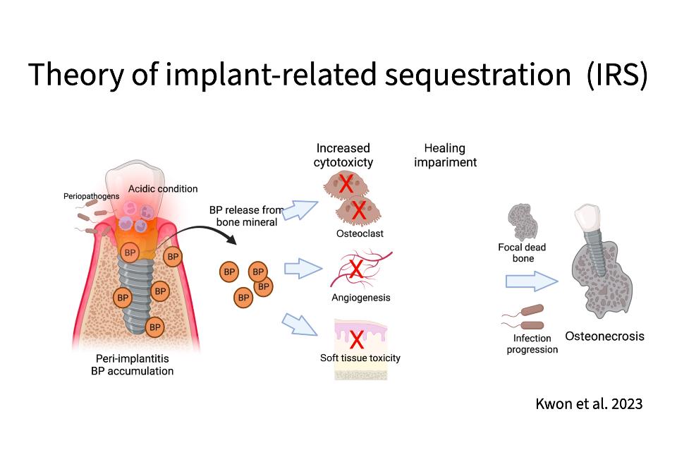 Fig. 15: Theory of implant-related sequestration/MRONJ introduced in review article 3 (Kwon at al. 2023)