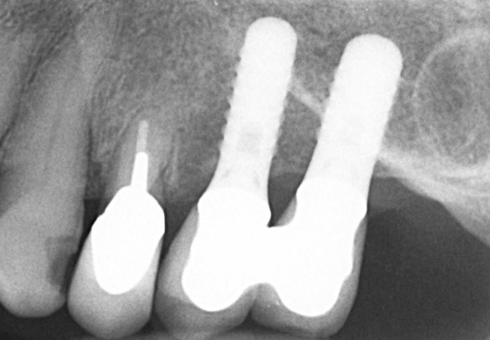 Fig. 7b: Radiographic status at the 20-year follow-up. The bone crest levels are excellent around the two TL implants. In the mid 1990s, crowns were routinely splinted following a SFE procedure. Today, such splinting is only done with short implants