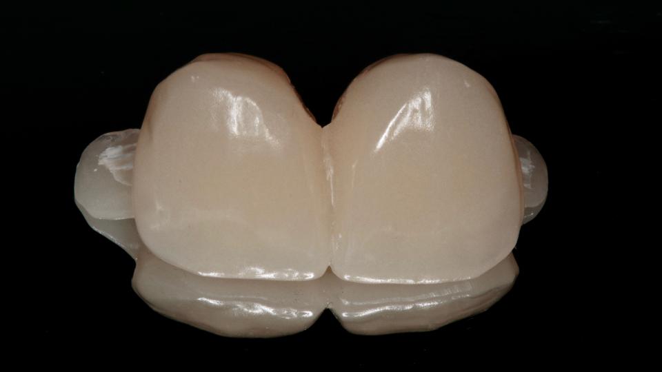 Fig. 8a: If immediate loading/restoration it is not possible, a provisional resin-bonded bridge may be an option during the healing period – buccal view