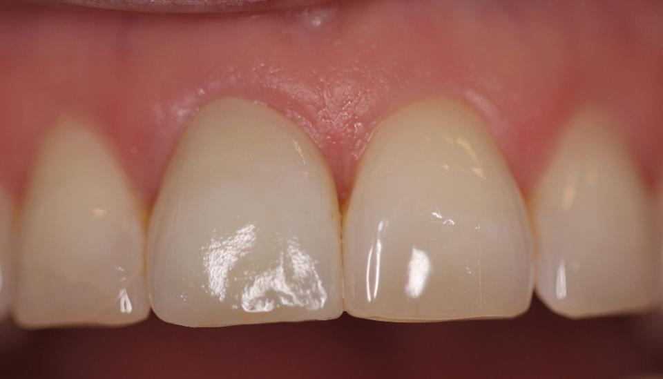 図9a: 自家移植。下顎第二小臼歯を11番部位に自家移植してから37年後の臨床像。移植歯はフルセラミッククラウンで補綴修復され、周囲の軟組織は健全に見える。