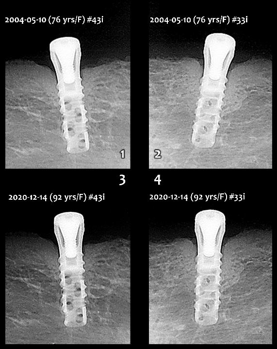 图. 14c: 第三优先级治疗选项。上颌为传统全口义齿，下颌为2颗种植体支持的覆盖义齿 (图3)。该义齿已经很好的工作了16年，自2004年以来没有出现任何种植体周围骨吸收 (ITI中空柱状，Straumann) (1 - 4)。定期复查的根尖片显示，直到2020年这2颗下颌种植体均未见骨吸收。
