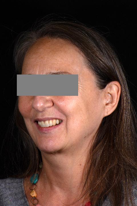 Fig 5c: Sourire gingival extra-oral après traitement - vue latérale.