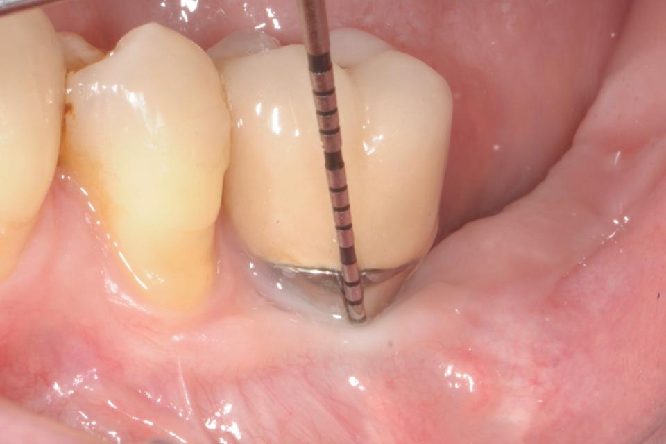 Fig. 4j: Probing at the buccal site in December 2014, showing the absence of inflammation and/or bleeding