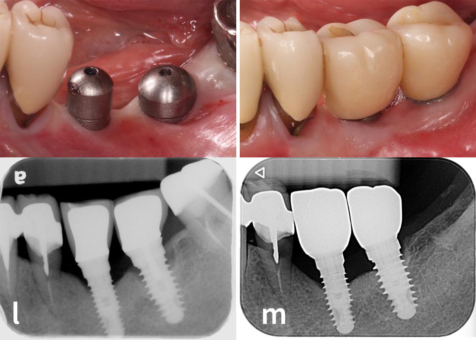 Abb. 2l–m: Vergleich der vor der Operation angefertigten intraoralen Fotografie und Röntgenaufnahme (l) mit den 5 Jahre postoperativ angefertigten Bildern (m)