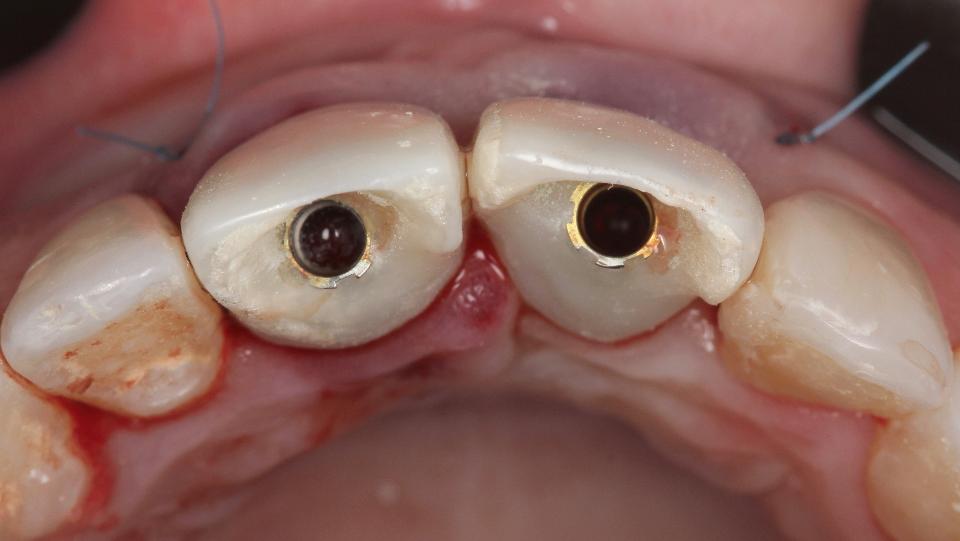 Fig. 7d: Type 1a protocol – occusal view after insertion of the immediate provisional crown