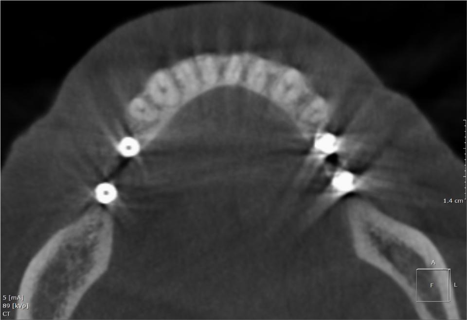 Fig. 1: Cone-beam computed tomography axial reconstruction of the mandible of a patient presenting four dental implants. Note the streak artifacts originating from each dental implant